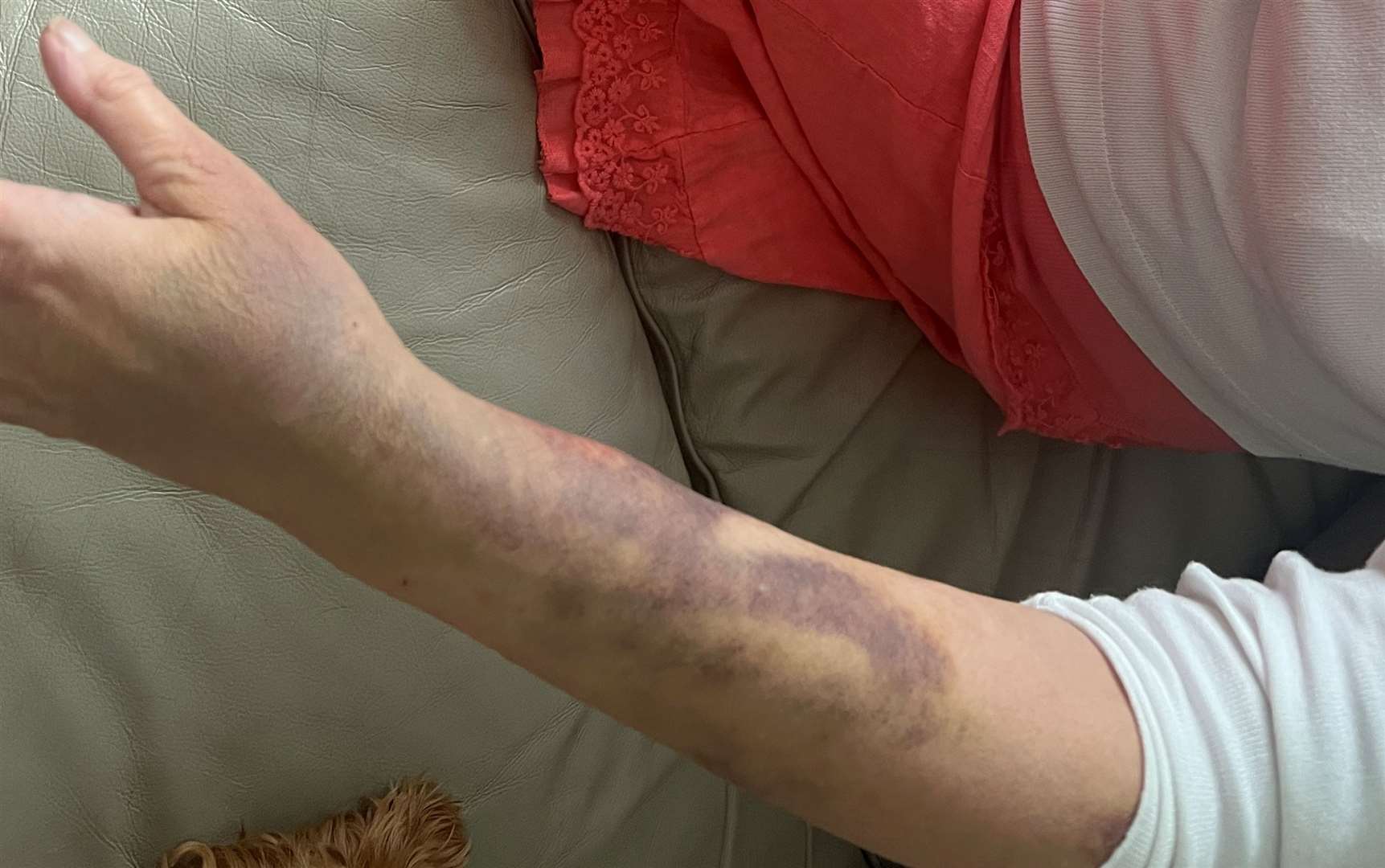 Ava Stanley's bruises from her angiogram procedure. Picture: Megan Carr