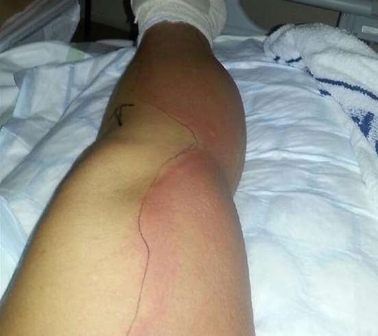 A rash spread up Alison's leg