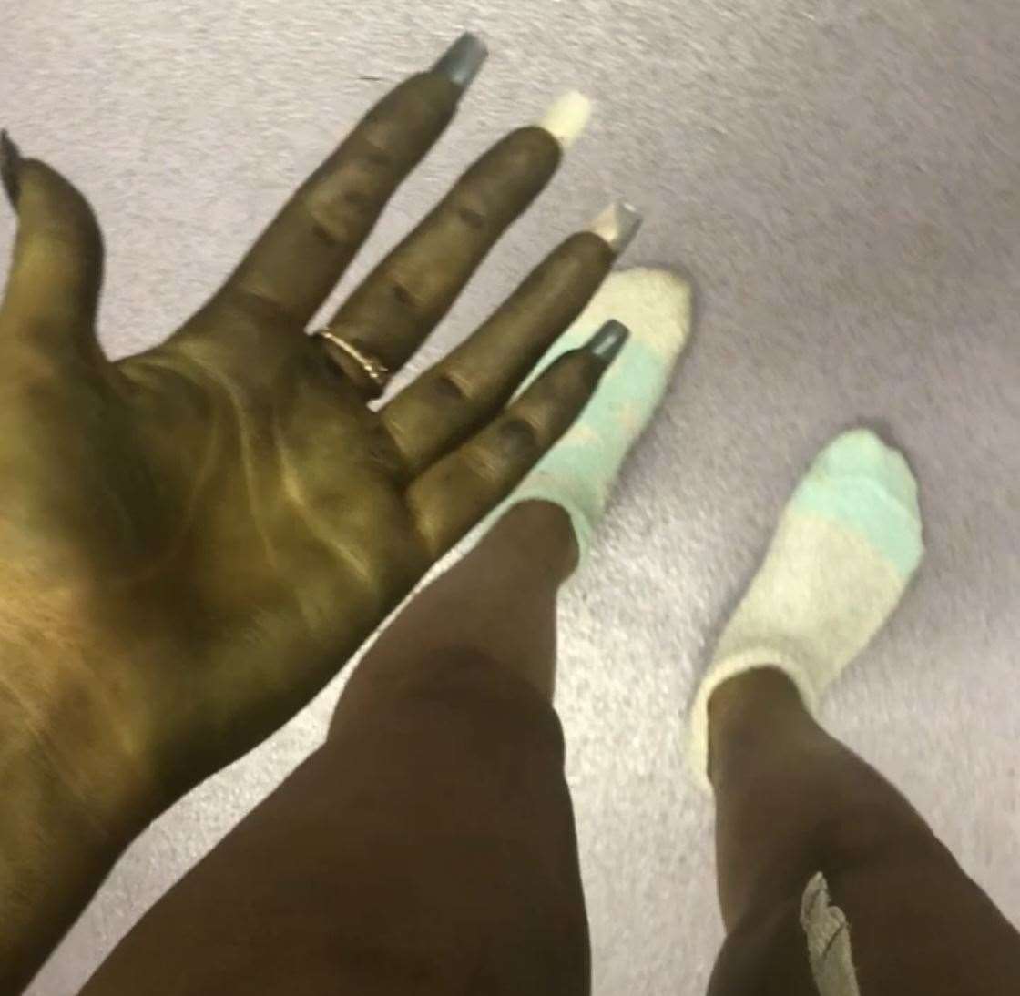 Lilly's hand after slapping fake tan on which turned her green. Picture: Lilly Vigus