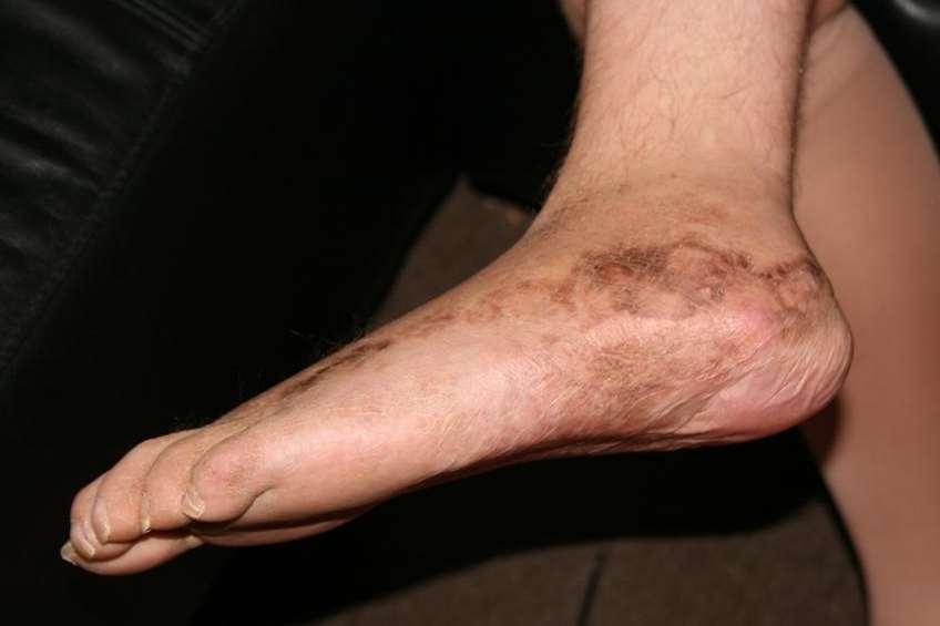 Peter Barton needed skin grafts and is suffering from foot drop