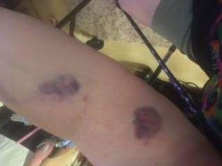 Bruises left on Sandra's arm