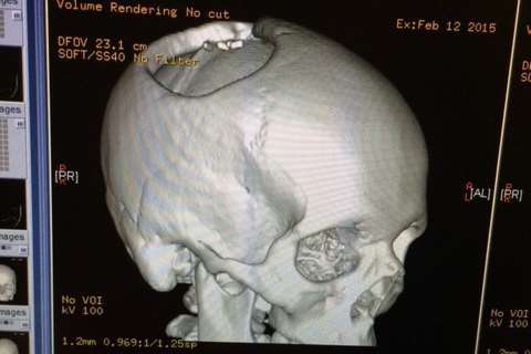 A 3D image of the 7cm hole in Chris's skull