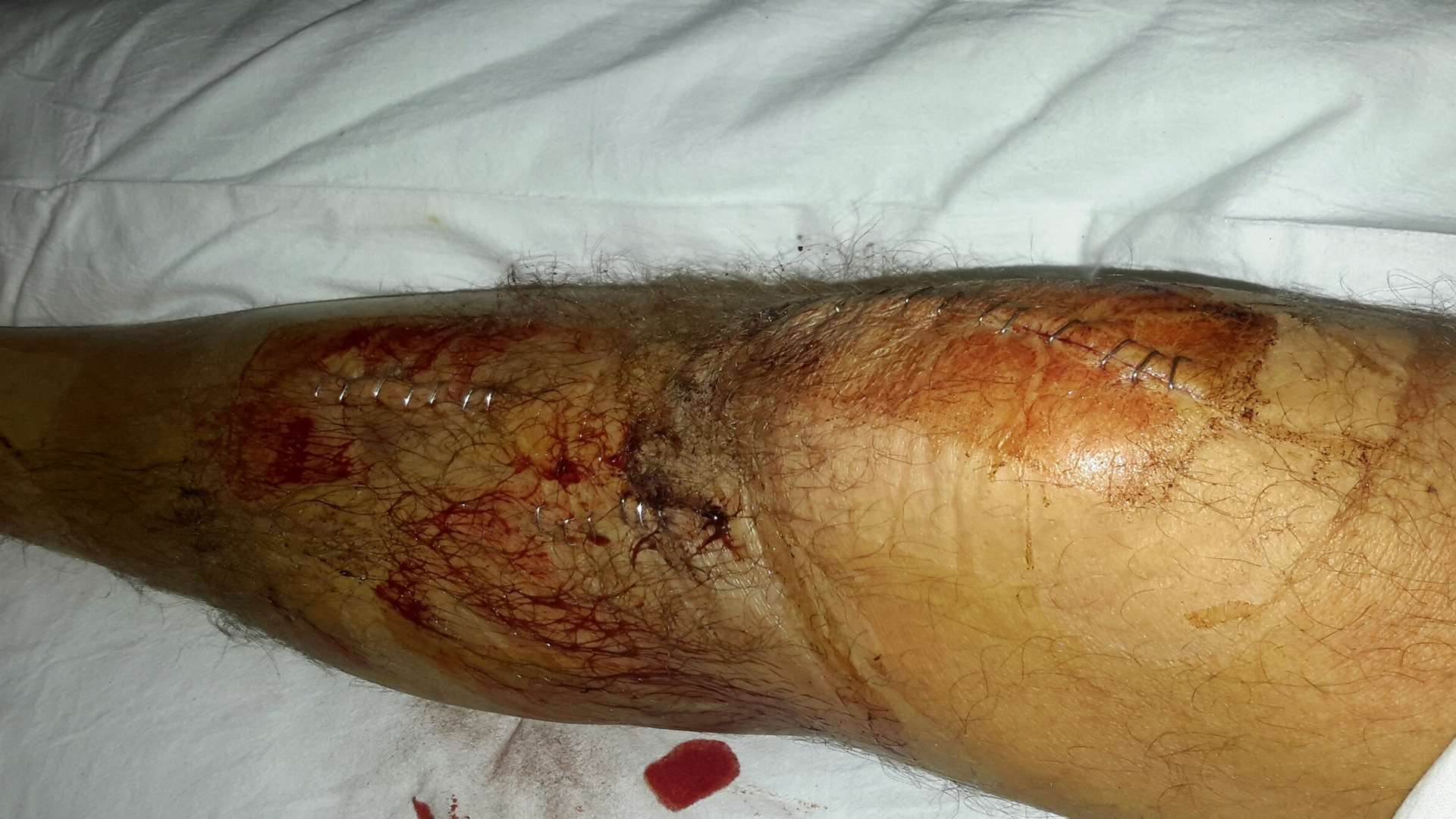 Mr Lawrence's leg after the incident