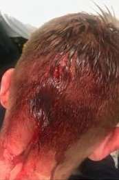 The younger victim pictured after the assault in Pelham Road, Gravesend