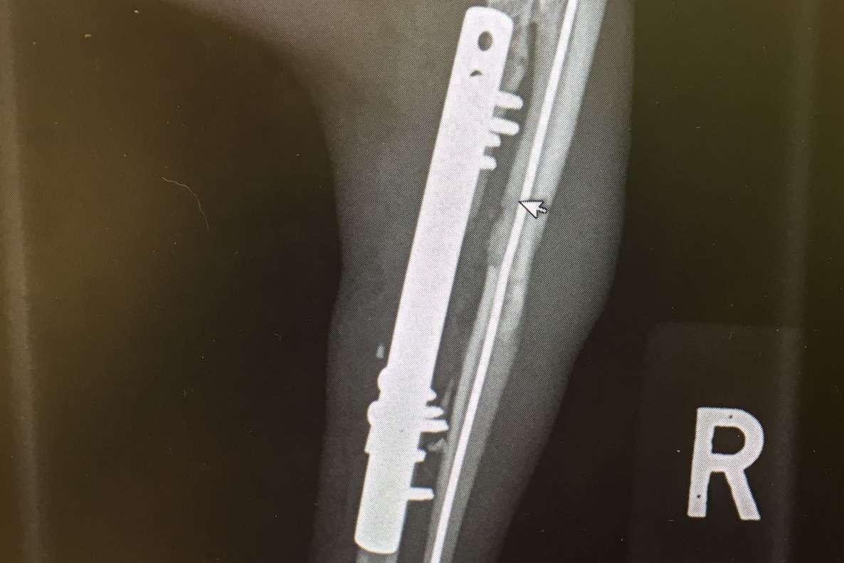 Metal was inserted into Nigel's broken legs