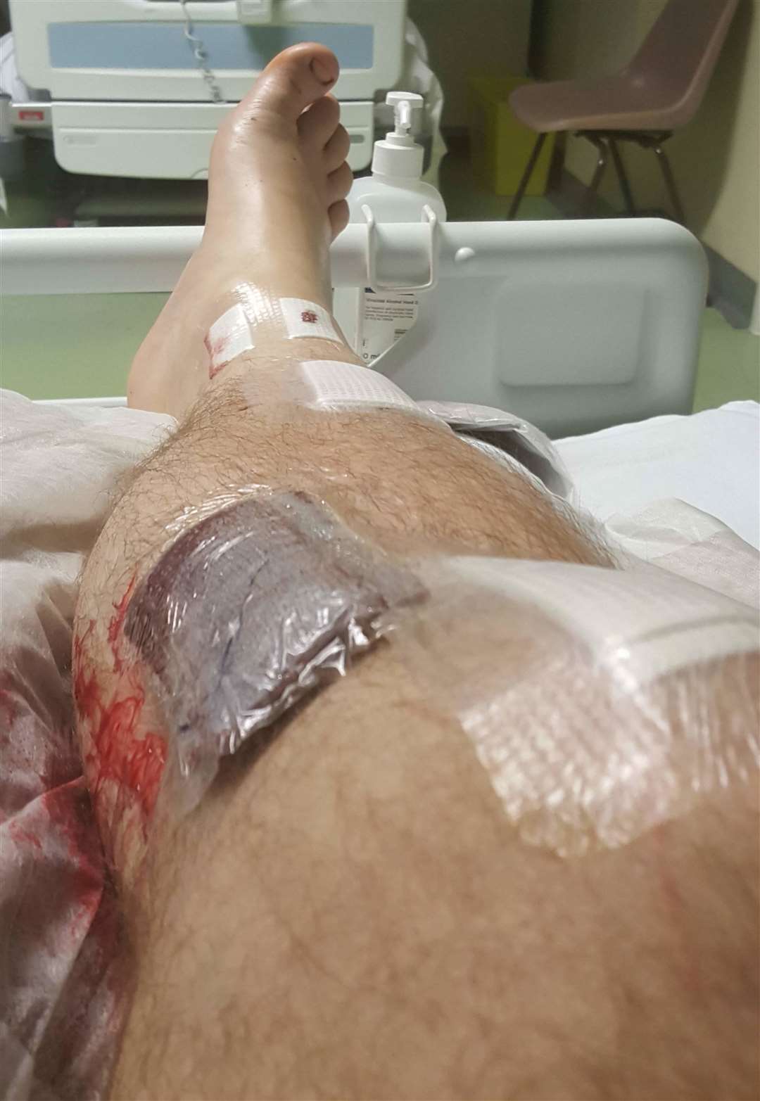 Mitch Peeke's leg after the operation to save it