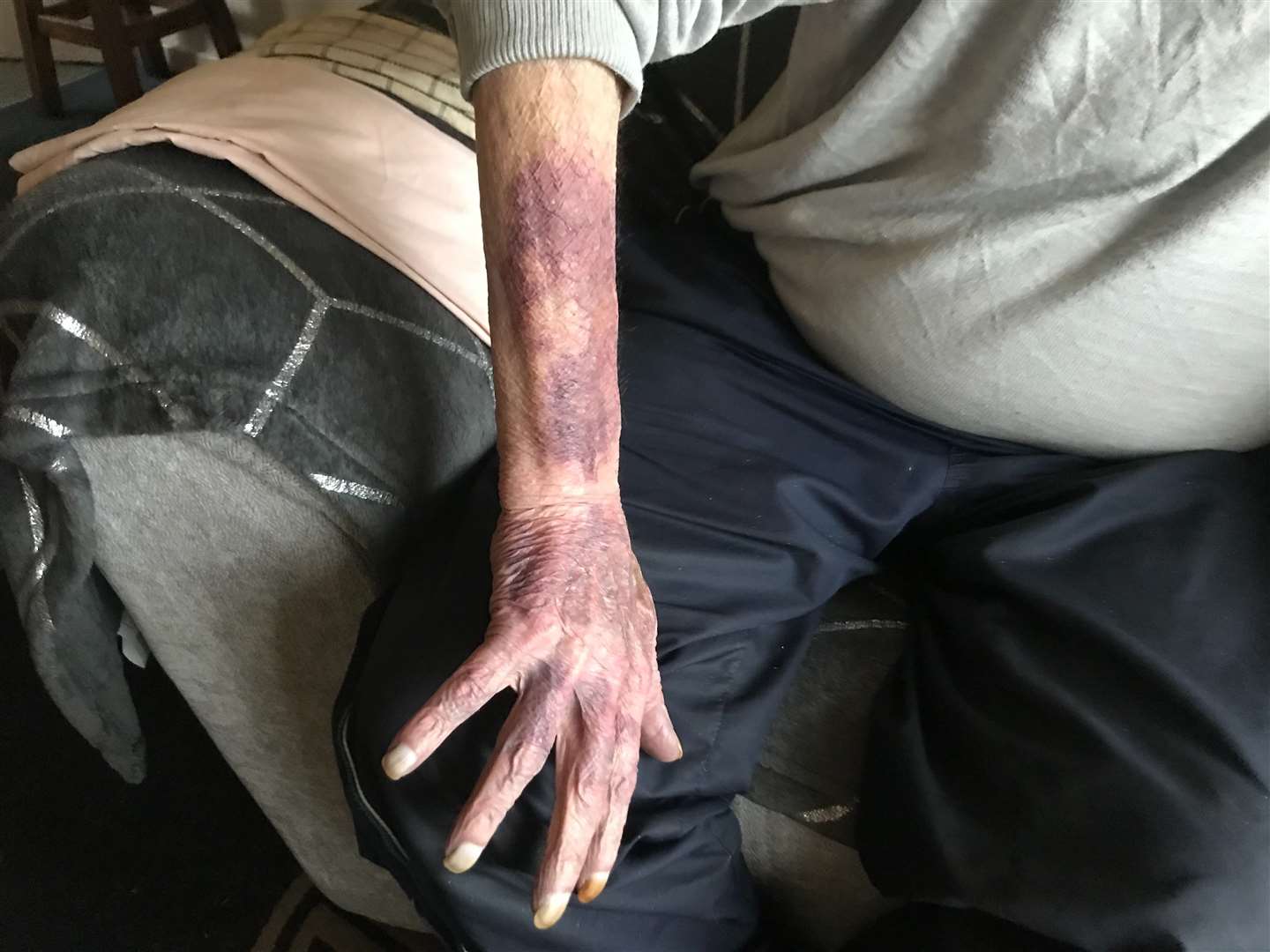 Arthur's bruised arm after the attack last year
