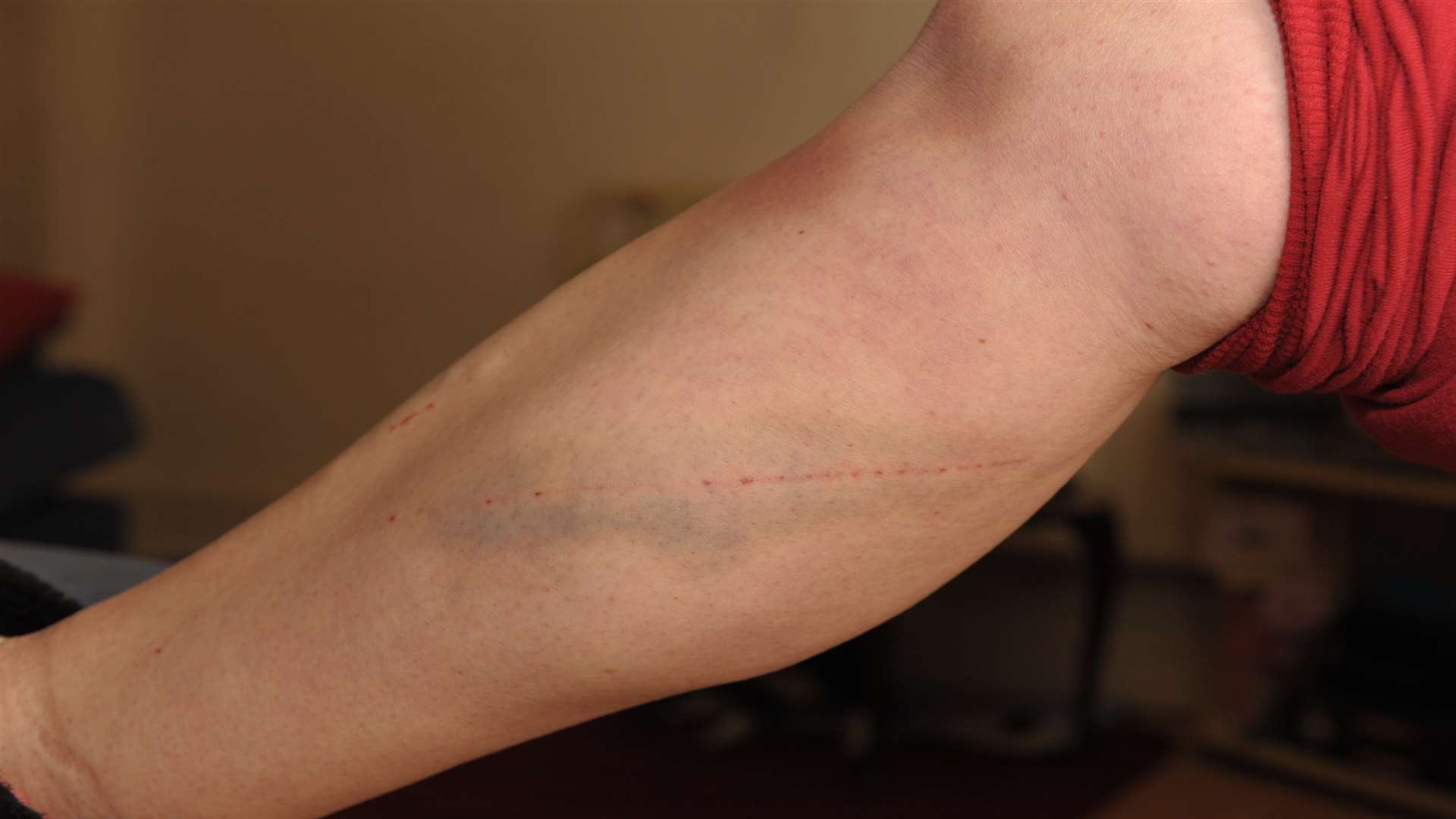 Vicky Swift's bruised leg