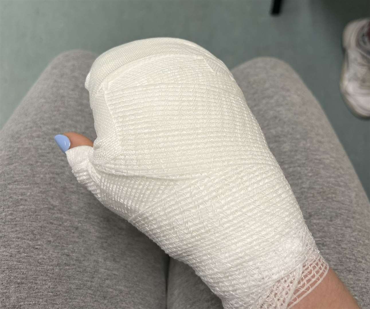 Lucy Jones got her hands wrapped at a pharmacy in Spain before going to A&E in Maidstone. Picture: Kennedy News