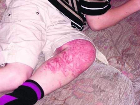 Jonathan Asplin's leg - still covered in sting marks