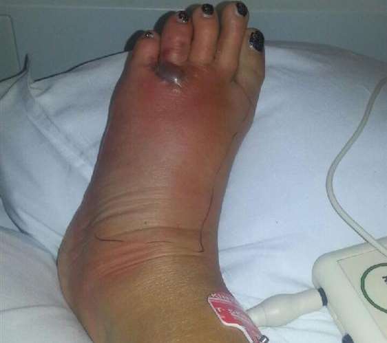 Alison Blackburn's foot was so swollen she could not get her shoe on