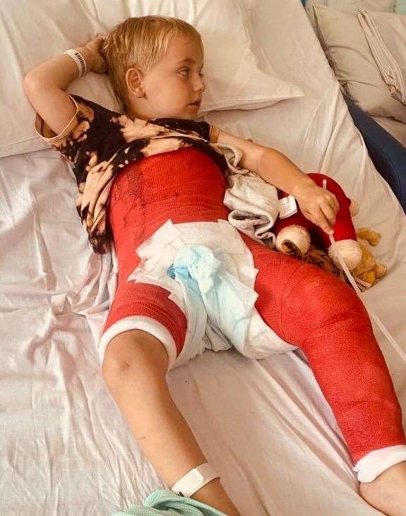 Thomas Sutcliffe is in a cast that covers a large part of his body after breaking his leg at nursery. Picture: Louise Sutcliffe