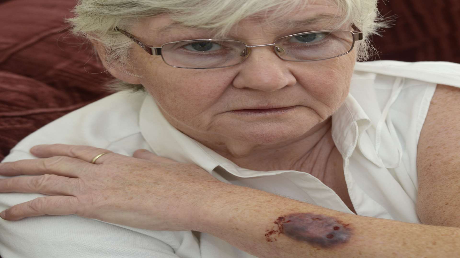 Christine Manser with the dog bite she received in her garden two months ago