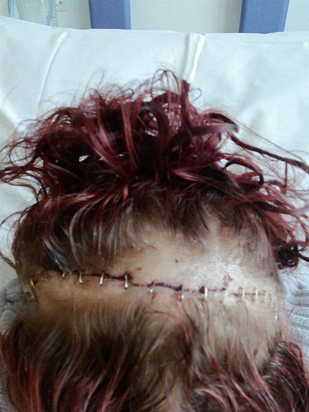 Toni Crews was left with a scar across her head after her second operation