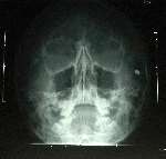X-RAY: This X-ray picture shows where the pellet entered Ashley's skull