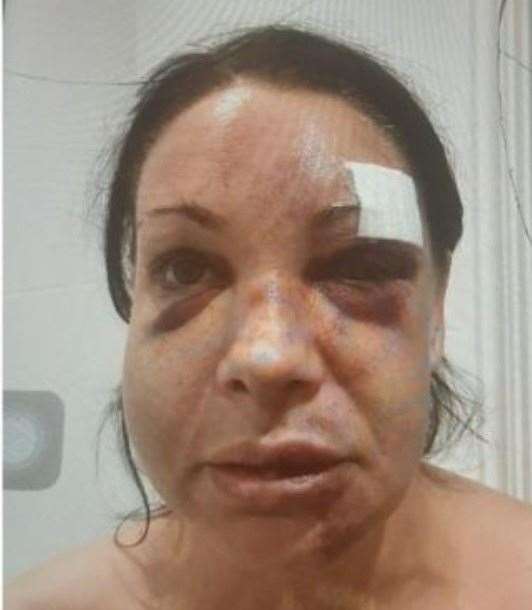 Gemma Robinson's injuries at the hand of her abusive former partner
