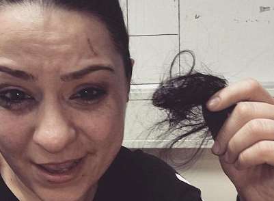 Lucy Spraggan posted pictures of her injuries on Instagram