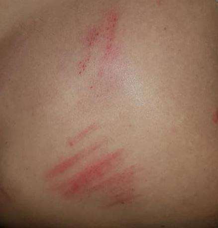 One of the boys was left with marks on his back. (6179948)