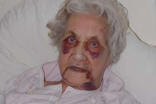 Jean McDougall suffered black eyes and multiple injuries after a savage beating by teenager Aron Davis