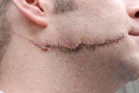 The wound required more than 40 stitches. Picture: KENT POLICE