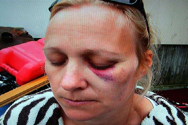 Denise Hasemore’s bruised eye after being punched in the face