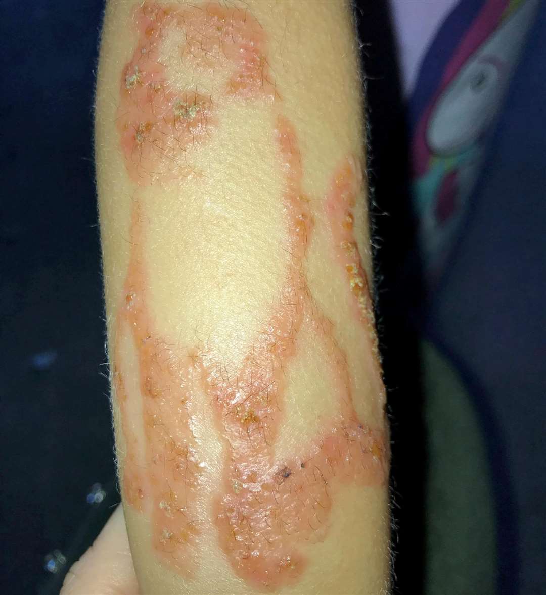 The henna tattoo caused Freja's arm to blister and burn (5886656)