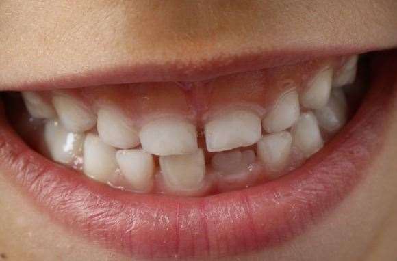 Children in Gravesham have the worst teeth. Stock image