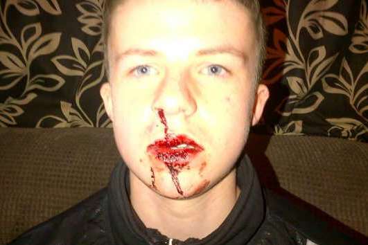 Teenager Aaron Scanlan needed an operation for a broken nose after the assault