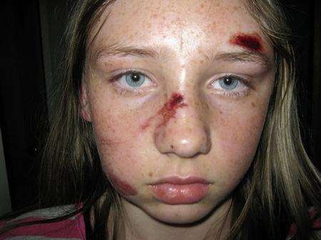 13-year-old Shannon Dring was left bruised and cut after she fell from a school bus.
