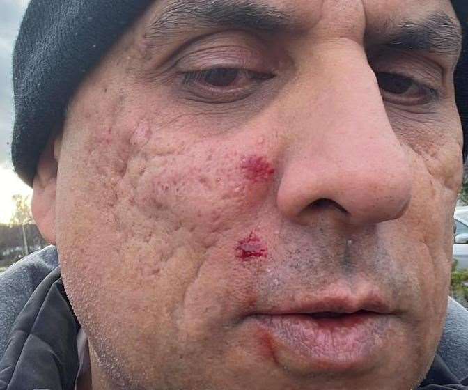 Sarbjit Mattu, from Lordswood, was punched in the face during a random attack