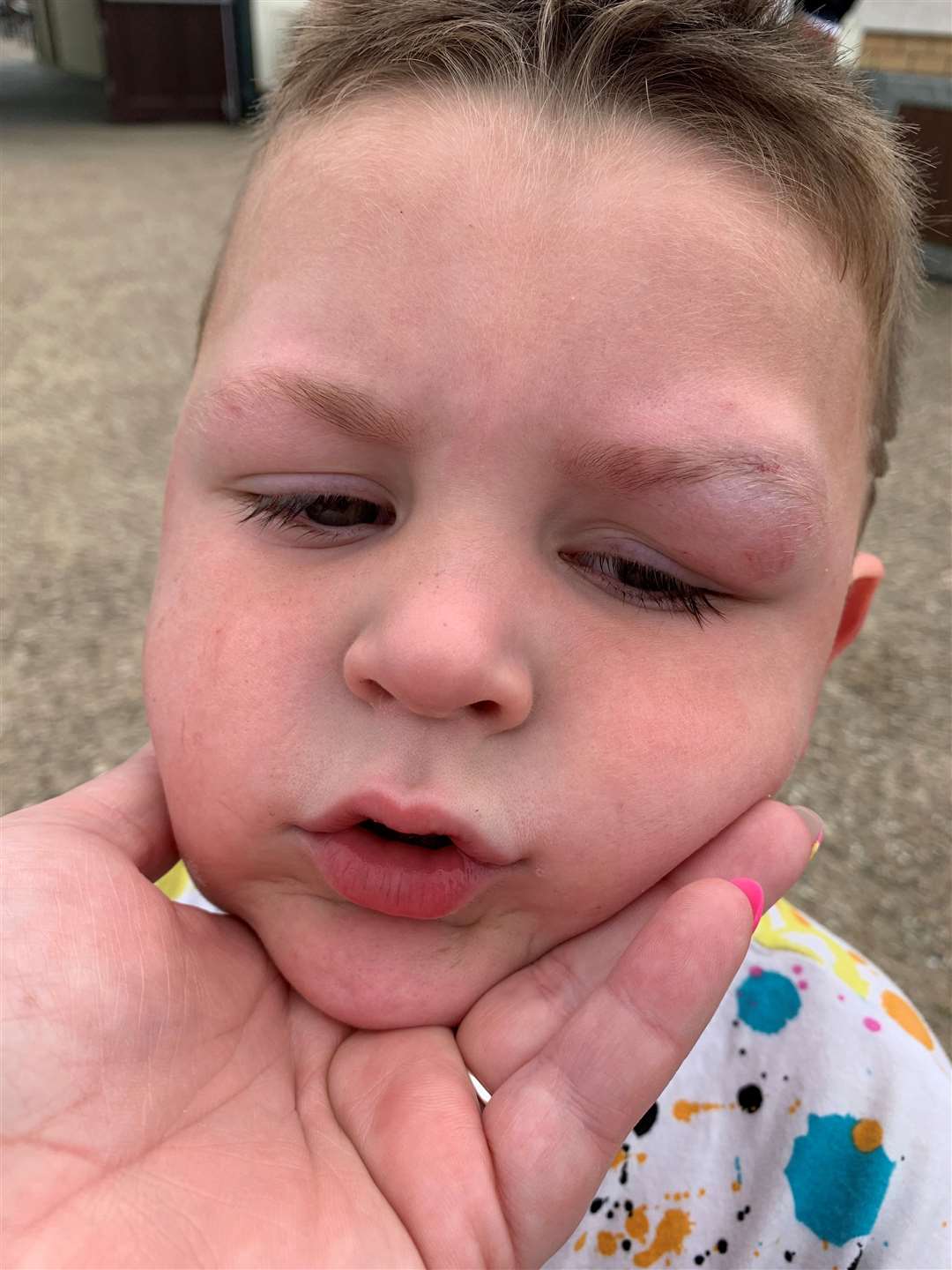 The swelling was noticable immediately after the four-year-old was conked on the head