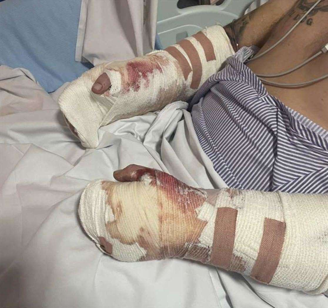 Steven Gilmore's hands after being electrocuted. Picture: Vicky Blackman