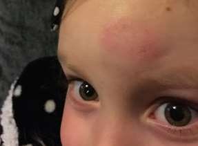 Millie Ellis, 5, with a big bruised lump on her forehead