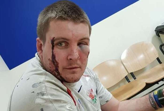 Anthony Bass was hit in the face by an object believed to have been launched by a catapult