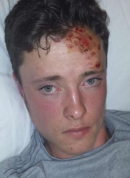 Teenager Dominic Evans was left with tyre marks on his body after a hit-and-run