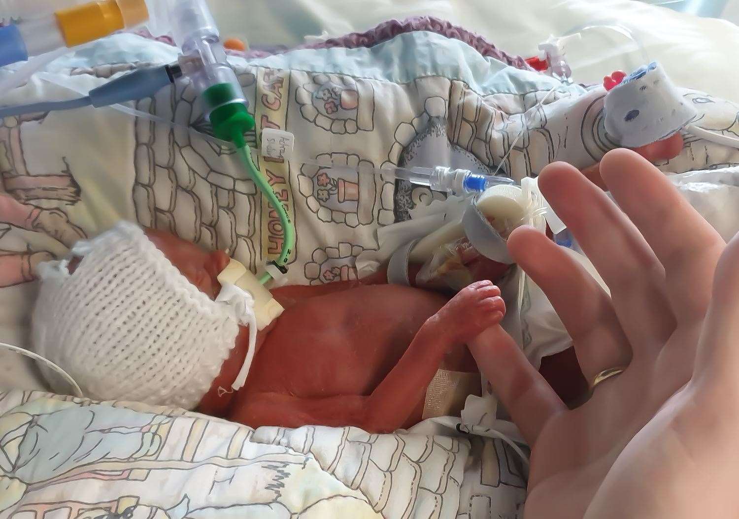 Oliver-Cash was born prematurely at Medway Hospital last year