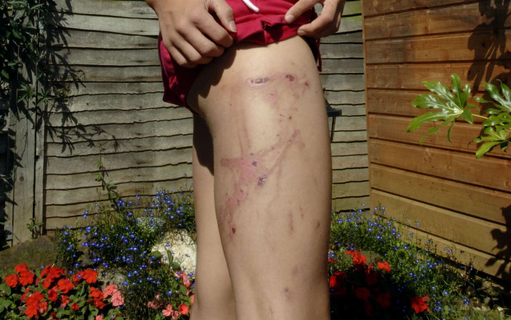 Scarring caused by contact with Giant Hogweed