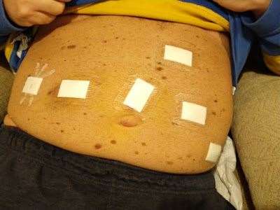 What Alastair's stomach looked like after his operation