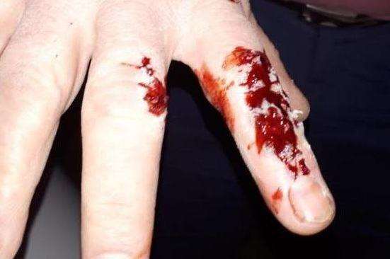 Jon Barrett's cut finger following the frightening incident