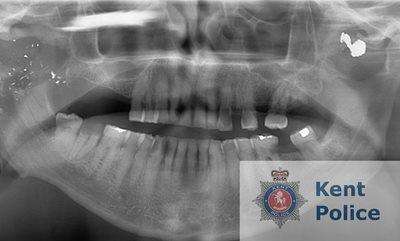 An x-ray of Ray Weatherall's face after the shooting