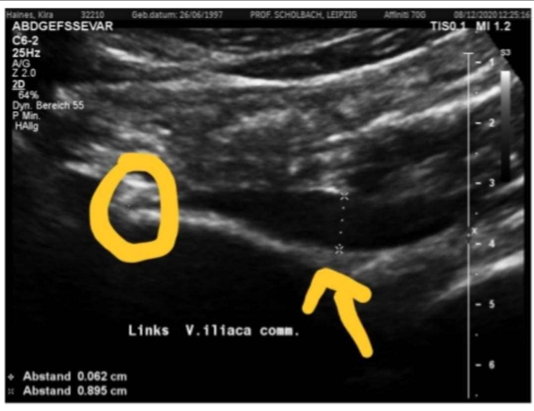 A scan showing Kira's veins. The arrow on the right shows the veins normal width, and on the left in the circle is the compressed vein