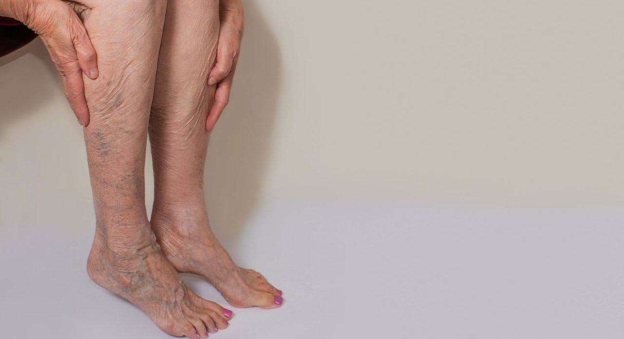 Varicose veins are very common, but they can also be painful, problematic, and unsightly.