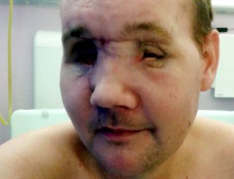 Andrew Foster lost one of his eyes and lost the sight in the other