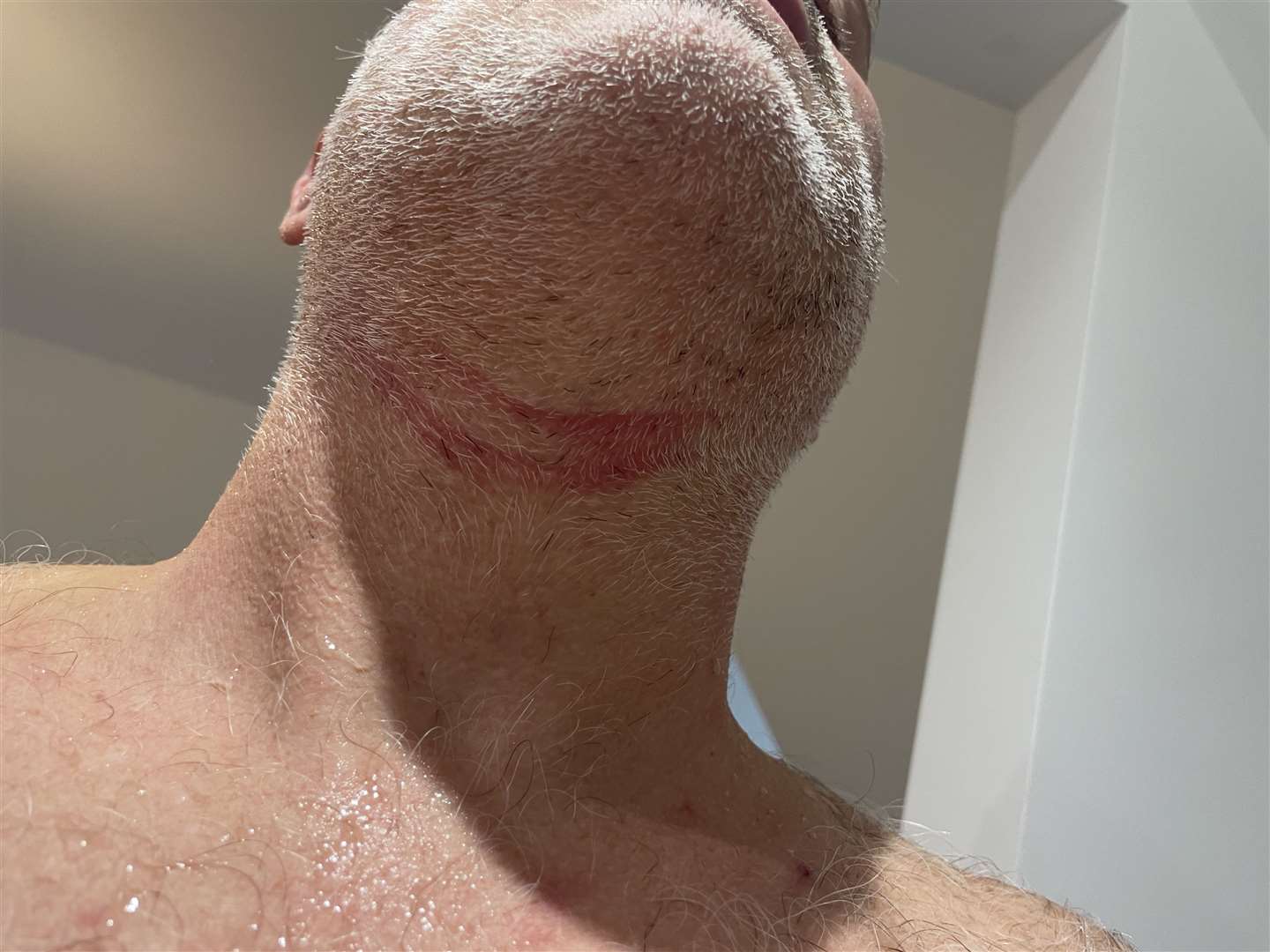 Keith Patrick's injuries to his neck after the road rage attack in Birchington. Picture: Keith Patrick