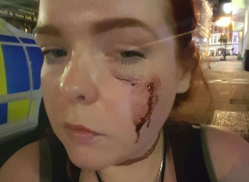 Jamie-Leigh Smith was left with significant bruising on her face