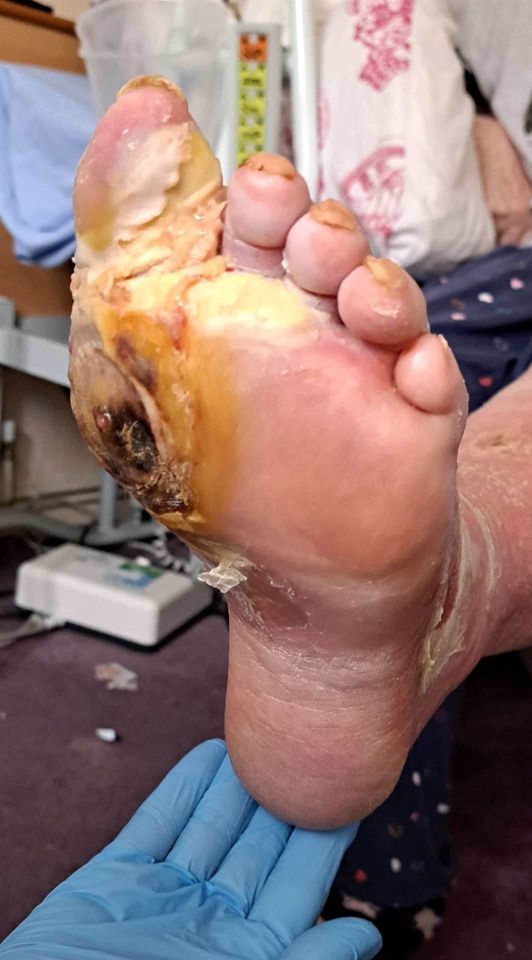 WARNING: Graphic image. Mrs Medhurst's foot developed an infection which led to three of her toes being removed. Photo: Family release