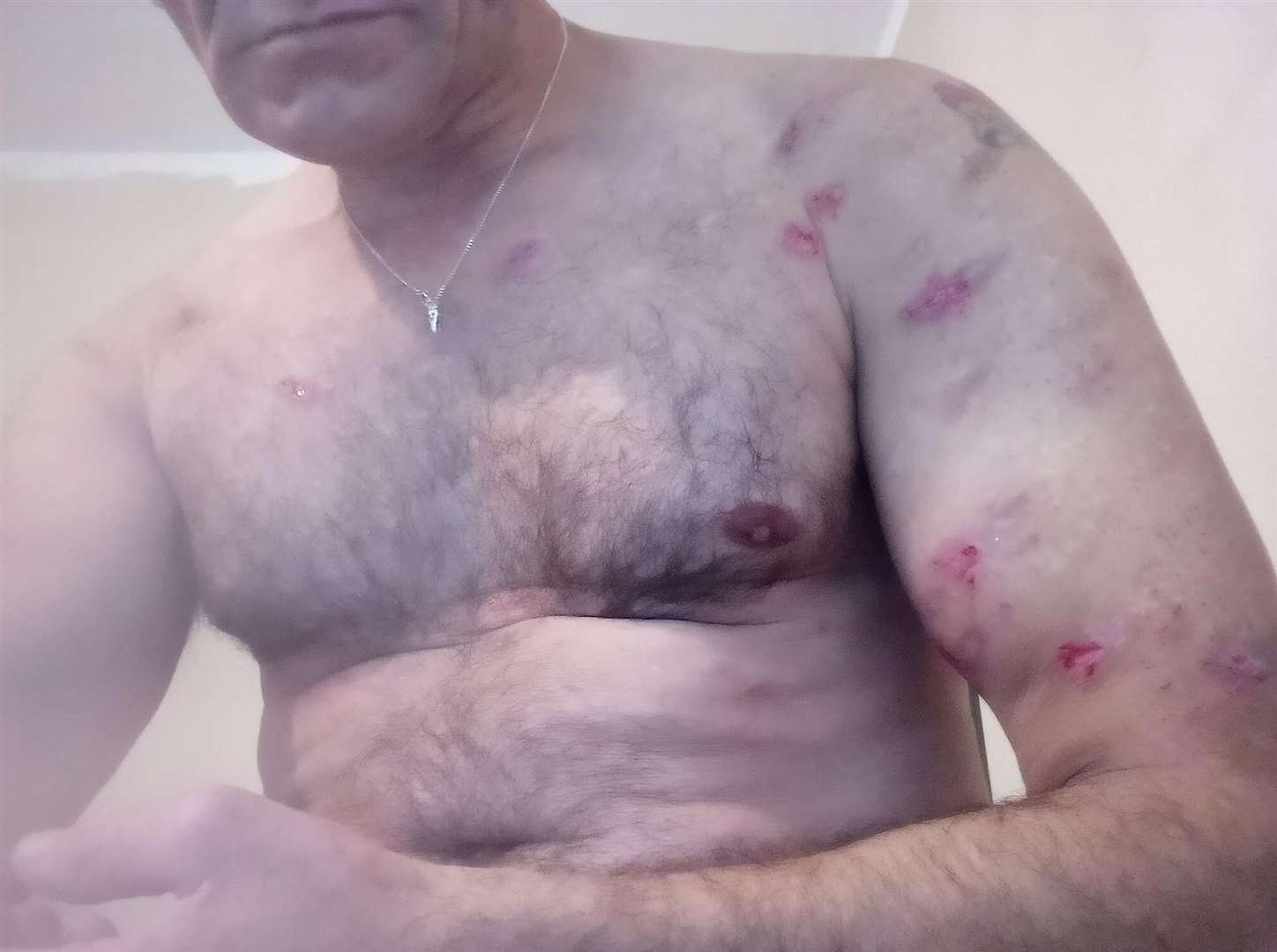 Russell has been bitten more than 100 times across his body, with new bites appearing daily. Picture: Russell Davis