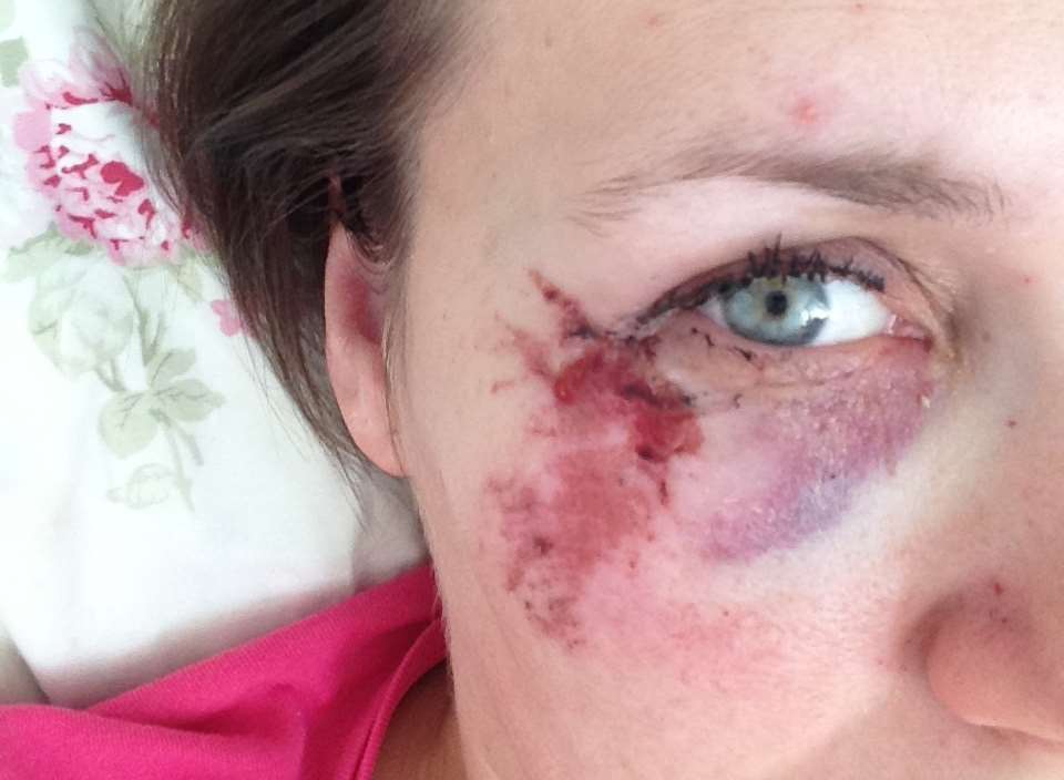 Jennie Ivinson was badly cut after a rock attack