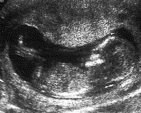 A baby scan at 12 weeks at Medway Maritime Hospital