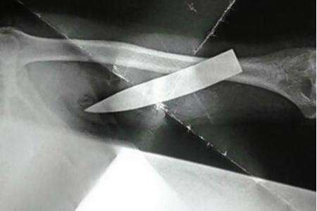 An x-ray showing the blade in Taitex Phlamachha's arm in Maidstone